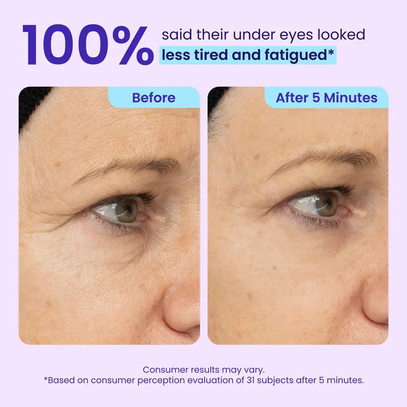Before and after under-eye result