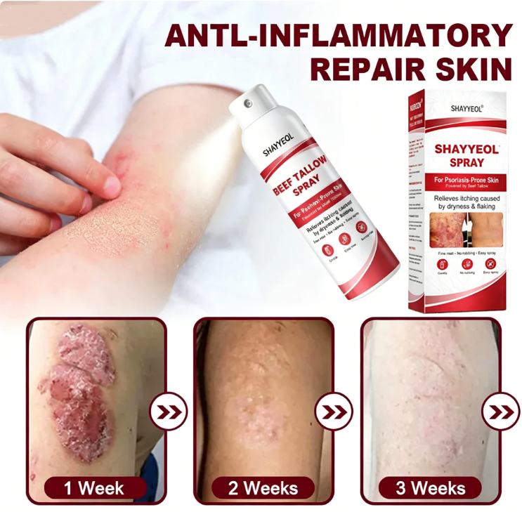 Beef Tallow Spray — Soothe & Repair Psoriasis Skin Fast | No-Rub ✨