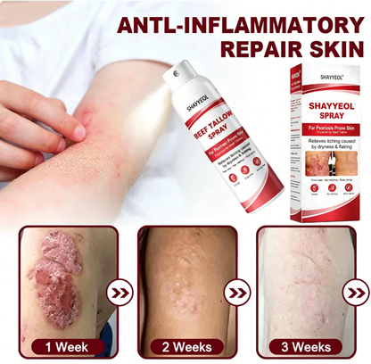 Beef Tallow Spray — Soothe & Repair Psoriasis Skin Fast | No-Rub ✨