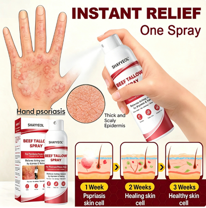 Beef Tallow Spray — Soothe & Repair Psoriasis Skin Fast | No-Rub ✨